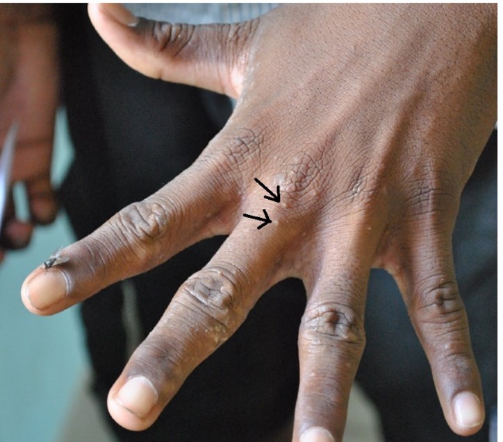 Typical skin appearance of scabies lesions: image courtesy of Dr Daniel Engelman