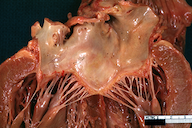 Thickened heart valves associated with rheumatic heart disease